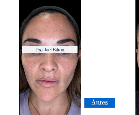 ANTES
