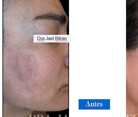 ANTES